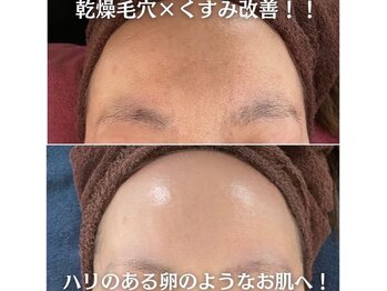 ファシル(Facile)/乾燥毛穴改善