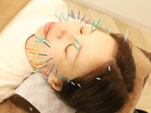 ウル鍼灸整骨院/【プレミアム美容鍼】