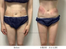 スラリ(SLARI)/【腹部・太もも　脂肪冷却】