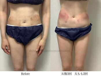 スラリ(SLARI)/【腹部・太もも　脂肪冷却】