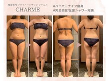 シャルム(charme)/ハイパーナイフ痩身/ダイエット