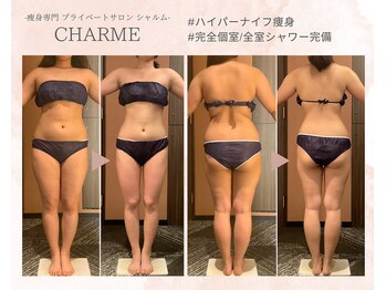 シャルム(charme)/ハイパーナイフ痩身/ダイエット