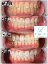 ホワイトベース(White Base)/before after