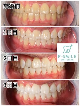 ホワイトベース(White Base)/before after