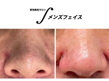 メンズフェイス 栄店の雰囲気（小鼻の毛穴洗浄で詰まった鼻の角栓もすっきり！全顔も出来ます♪）