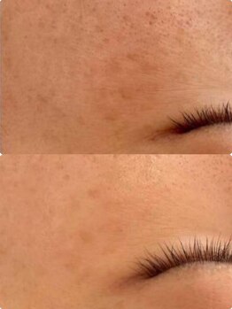 ラエッセ 恵比寿(LAESSE)/毛穴・美白専門店 LAESSE 恵比寿