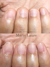 マリーロール 梅田店(Marie Laure)/深爪矯正/自爪育成/自爪風