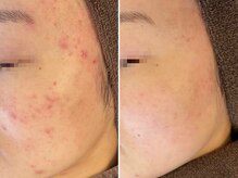 リッチ(Rich+)/ハーブピーリング