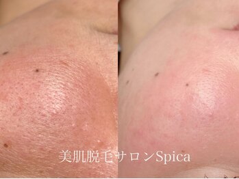 スピカ(SPICA)/産毛が取れて艶肌ゲット!