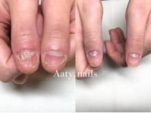 アーティネイルズ(Aaty Nails)/【深爪矯正】ハンド