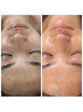 デイジー/乾燥肌のニキビにグリーンピール