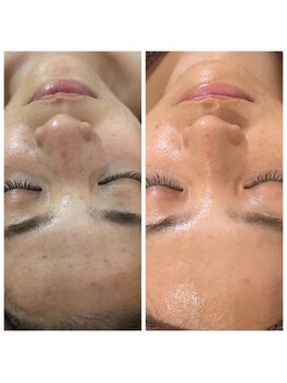 デイジー/乾燥肌のニキビにグリーンピール