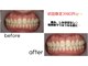 歯のホワイトニング　Salon E'clatの写真