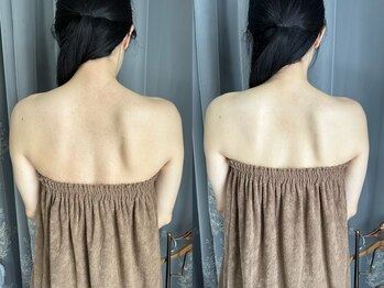 ムーンサン(Moon sun)/背中ピーリング