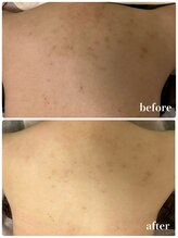 リリィブラン(Lily branc)/Body美白ピーリング/ニキビケア