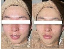 ピーロ(PiiiLO)/施術例/ソフト3回+ディープ2回