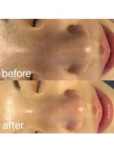 ナナラ(nanala)/毛穴洗浄