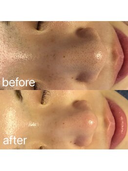 ナナラ(nanala)/毛穴洗浄