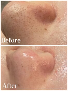 ミーアップ(Me up)/毛穴特化コースもございます!