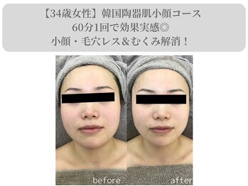 エターナルフレーム(Eternal Flame)/陶器肌小顔NFフェイシャルコース