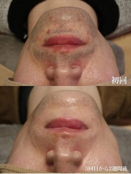 ベビースキン(baby skin)/髭脱毛