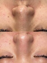 韓国肌管理室ハナ(hana)/肌質改善/毛穴洗浄/毛穴洗浄大阪