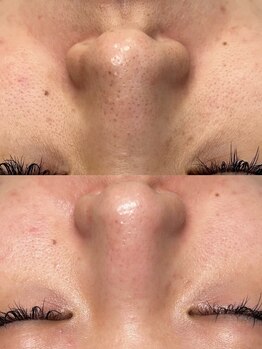 韓国肌管理室ハナ(hana)/肌質改善/毛穴洗浄/毛穴洗浄大阪