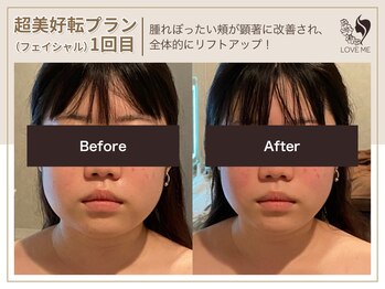 ラブミー 渋谷本店(LoveMe)/小顔・たるみ・ほうれい線・毛穴