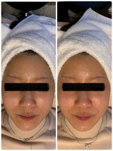 シュガー(Sugar...iyr)/光フェイシャル