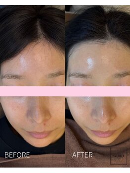 ギルドハナレ(GUILD HANARE)/"ハーブピーリング"