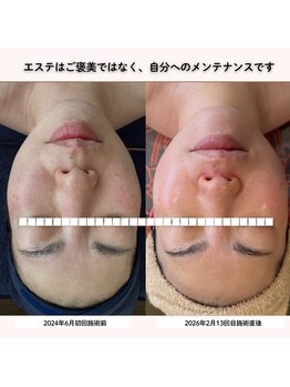 ココロ(COCORO)/人気No.1 ラミネーションピール