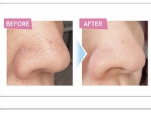 バルブ(BaREB)の雰囲気（毛穴洗浄ハイドロスプラッシュ導入◎ [新宿/メンズ眉毛サロン]）