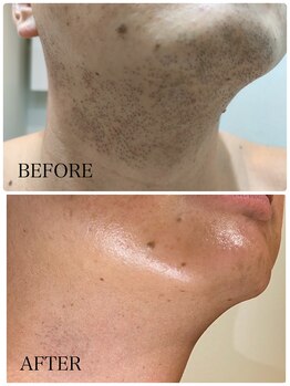 トゥルリア(TRULIA)/ハイブリッド脱毛6回目