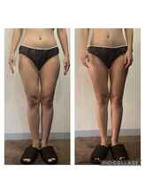 サロンドココ(Salon de COCO)/ハイパーナイフ痩身