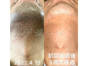 デジール/【メンズ脱毛/ニキビケア】