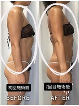 レチカ(Rechica)/吸い上げ（吸引）＋ラジオ波