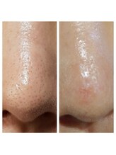 モアサロン(MOA salon)/毛穴洗浄黒ずみ開き毛穴集中ケア