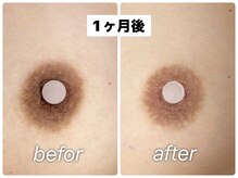 エリィ ワックス(erii wax)/《ルメラ×erii》経過途中/1ヵ月