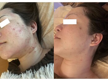 ルポ 那覇(repos)/肌トラブル特化美容鍼(100分)