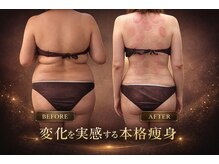 寧々/カッピングで背中もスッキリ