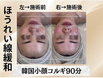 イヨヨ(iyoyo)/【小顔コルギ90分】Before After