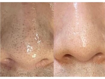 アルト(ALTO)の写真/毛穴黒ずみ・いちご鼻・たるみ毛穴・開き毛穴を集中ケア!つるん肌へ♪