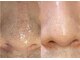 アルト(ALTO)の写真/毛穴黒ずみ・いちご鼻・たるみ毛穴・開き毛穴を集中ケア!つるん肌へ♪
