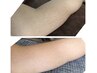 Wax脱毛 膝下+肘下 足指・手指のWaxプレゼント 11.000円