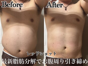アンドエス 六本木(and S.)/最新脂肪分解でお腹引き締め！