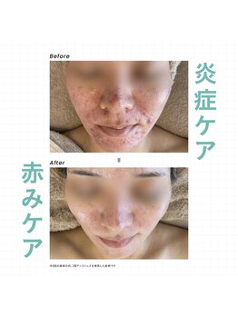 キヌ(KINU)の写真/【抜群の鎮静力と保湿力】クリスティーナのアンストレスで肌表面の水分と油分のバランスを整えましょう◎