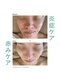 キヌ(KINU)の写真/【抜群の鎮静力と保湿力】クリスティーナのアンストレスで肌表面の水分と油分のバランスを整えましょう◎