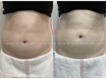 オプレア 千種店(OPREA)/【比較写真】痩身