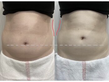 オプレア 千種店(OPREA)/【比較写真】痩身