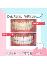 エクシアホワイトニング 札幌中島公園店/BeforeAfter［ホワイトニング］ 